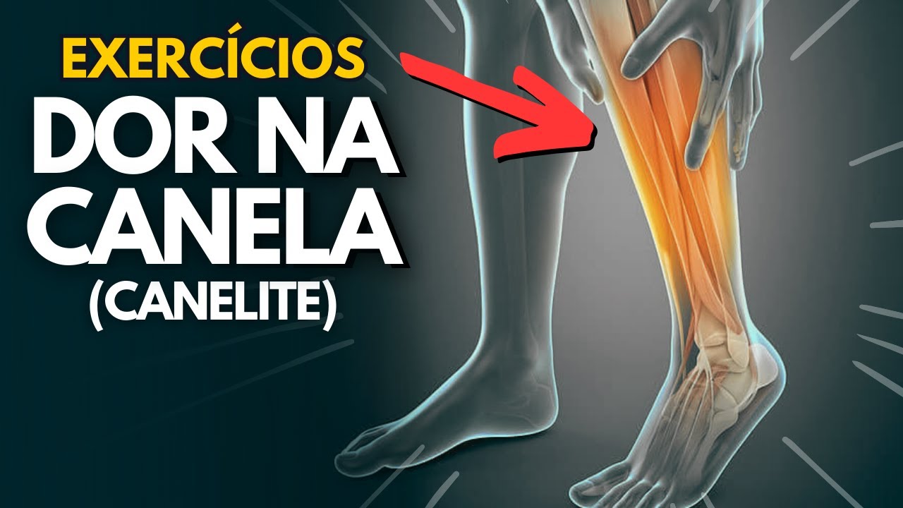 COMO TRATAR A CANELITE COM APENAS 4 EXERCÍCIOS SIMPLES