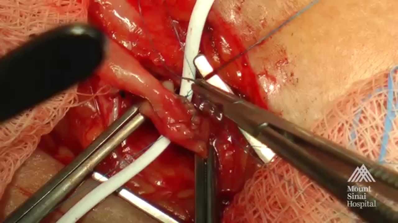 THE MOUNT SINAI SURGICAL FILM ATLAS: Arteriovenous Fistula