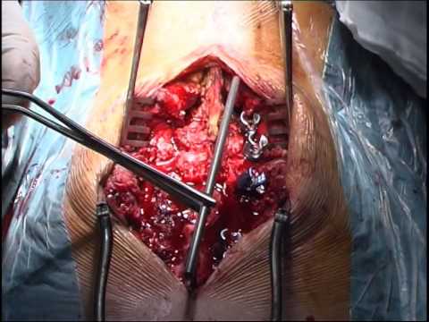 Ferite fortemente e tira indietro durante la gravidanza Dislocazione di anatomia dellarticolazione dellanca