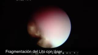 Ureterolitotricia In Situ Láser Dr. Lenin Rojas Buendía
