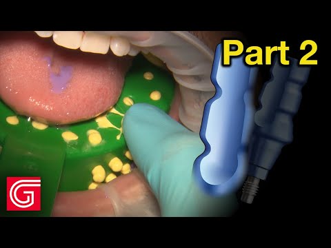 How To Take Closed Tray Implant Impression for Tooth #19