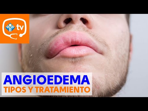 Angioedema: Tipos y tratamientos