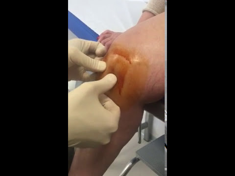 Dolore al collo nella parte posteriore dà Dolore nella parte sinistra della schiena durante la gravidanza