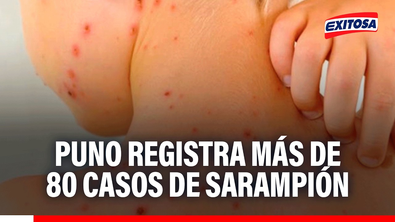 🔴🔵 Puno registra más de 80 casos de sarampión, brigadas de salud han intensificado la vacunación