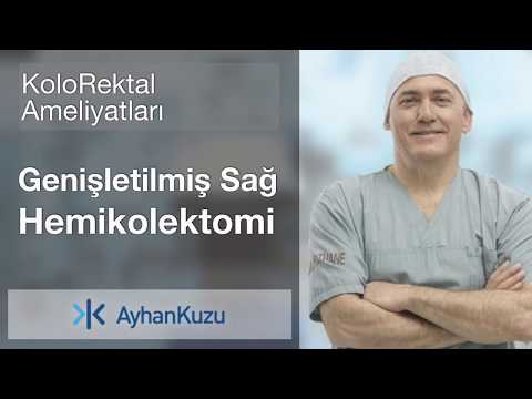 Kolorektal Ameliyatları #4 - Genişletilmiş Sağ Hemikolektomi