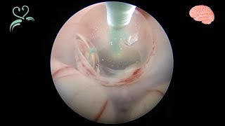 Endoscopic Third Ventriculostomy - Beyin ve Sinir