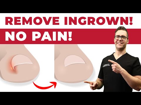 HUGE Foot PIMPLE filled with dead FAT Crystals