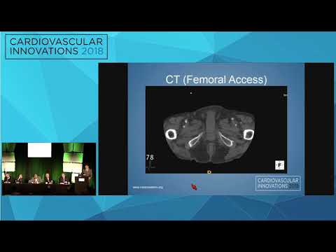 CVI2018 Session: TAVR complication surprise - Ankur Kalra, MD