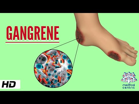 Gangrene, Causes, Signs and Symptoms, Diagnosis and Treatment.