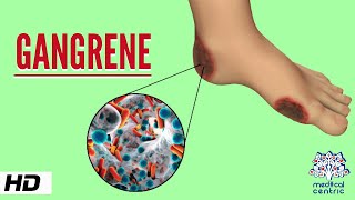 Gangrene, Causes, Signs and Symptoms, Diagnosis and Treatment.