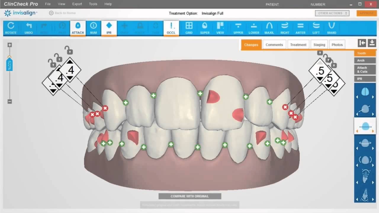 ClinCheck Pro Correção A P e Linha Média - Sistema Invisalign - Blumenau SC
