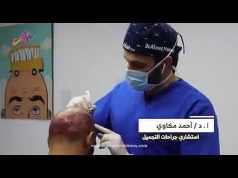 من أهم المراحل في زراعة الشعر هي مرحلة الرسم وتوزيع الجرافتات