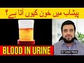 Blood In Urine Peshab Mein Khoon Ki Waja Pesab Karne Me Blood Aana Peshab Laal Hematuria Ka Ilaj