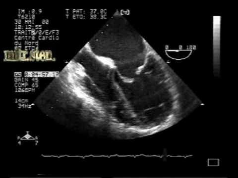 Mitral Stenosis In Different Aspects: Mitral Stenosis in TEE