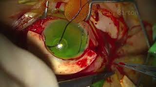 A confusing case of hypotony in Marfan's syndrome