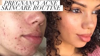 PREGNANCY ACNE | HOW TO CONTROL BAD BREAKOUTS