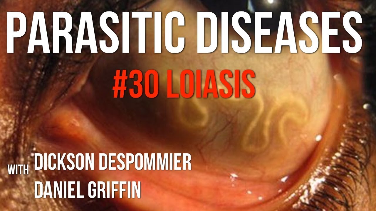 Parasitic Diseases Lectures #30: Loiasis - YouTube