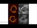 OCT (Optical Coherence Tomography)- Elias Hanna, Univ of Iowa