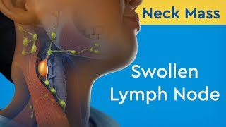 Neck Mass: Swollen Lymph Node