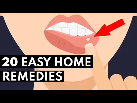 How To Get Rid Of Canker Sores FAST