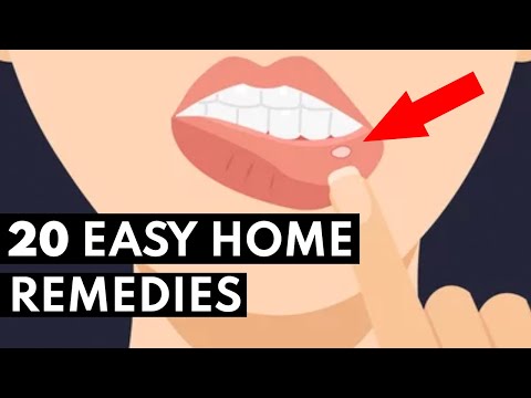 YouTube video about: Can I get my teeth cleaned with a canker sore?