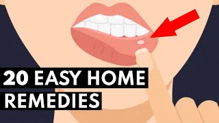 How To Get Rid Of Canker Sores FAST