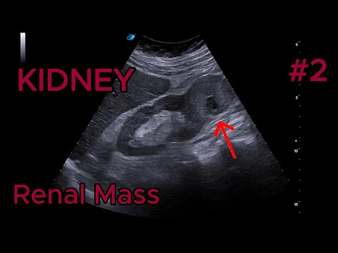 Solid Renal Mass video preview
