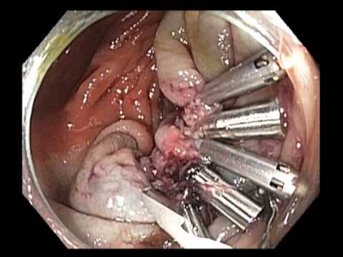 Clip Closure Technique of a Large Cecal Resection Defect