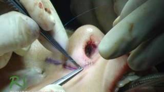 Live Rhinoplasty | Nostril Reduction