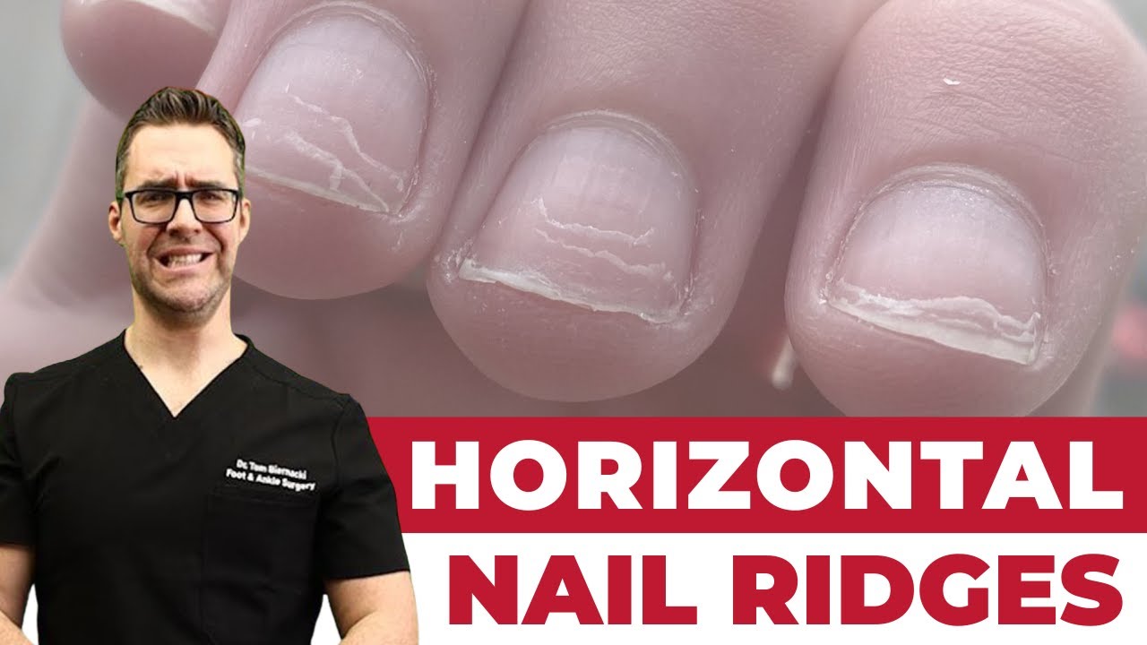 Horizontal Ridges on Nails?  [What Does It Mean?]