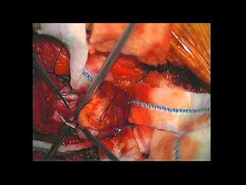 download lagu mp3 mp4 Neuro Surgery, download mp3 Neuro Surgery free downloadn, video klip Neuro Surgery