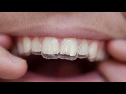 A është i vlefshëm abdesi nëse kemi vendosur proteza plastike? - Dr. Imam Ahmed Kalaja