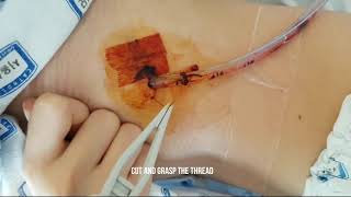 Asvide: Technique for chest tube removal