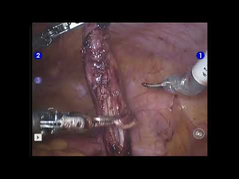 Robot-assisted bilateral ureteric stone removal with tailored ureteral reimplantation for congenital megaureter