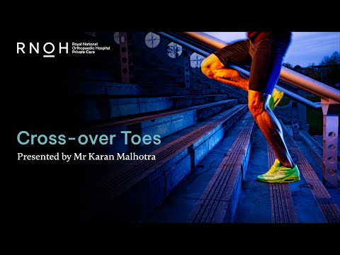 Cross over toes - Mr Karan Malhotra