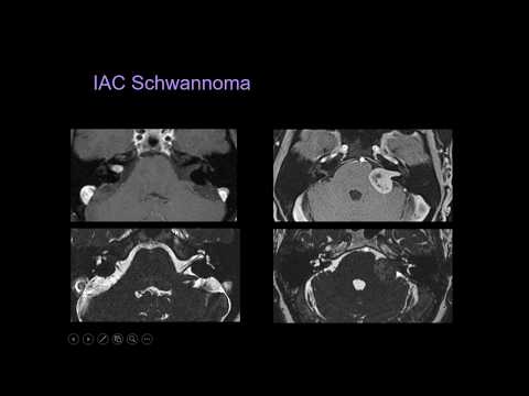 Cranial Nerves MRI Diagnostics - Part 2 - [Basic Radiology]