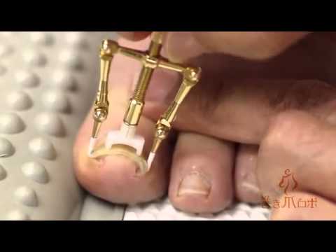 El tratamiento de los dedos rotos de las uñas El tratamiento del hongo de las uñas en la reina