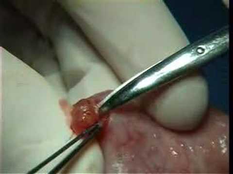 Surgical Removal of Mucocele from Lower Lip