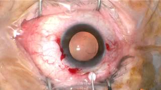 Handling Eyes Together - Case # 4