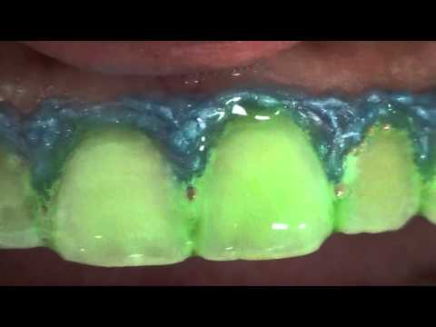 CURSO CLAREAMENTO DENTAL | Odontologia Estética UFPel