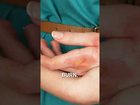 How to Treat a Skin Burn ? | Skin Burn Treatment | #shorts