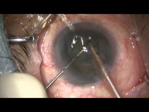 Endoscop oftalmic