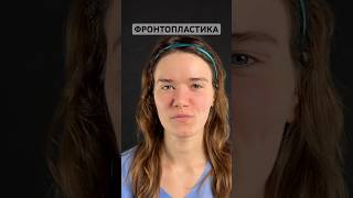 Пластика лба (фронтопластика) 29