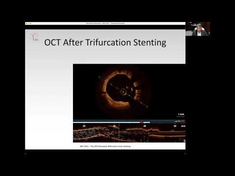 Double TAP in LM trifurcation - Dr Rony MATHEW