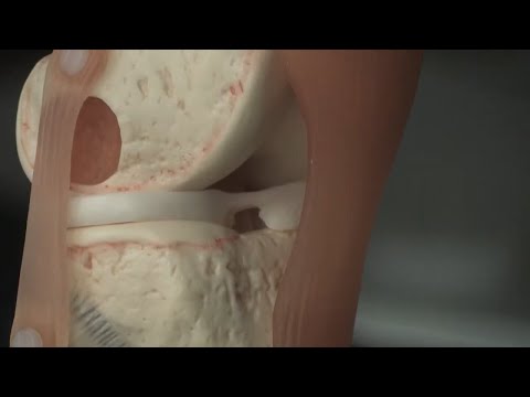 Erosive Osteochondrose der lumbalen Ein Fahrrad ist nützlich für die Gelenke