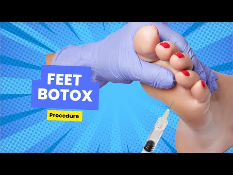 Feet Botox for Sweating