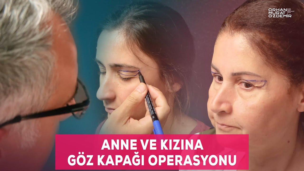 Anne ve Kızına Üst Göz Kapağı Operasyonu
