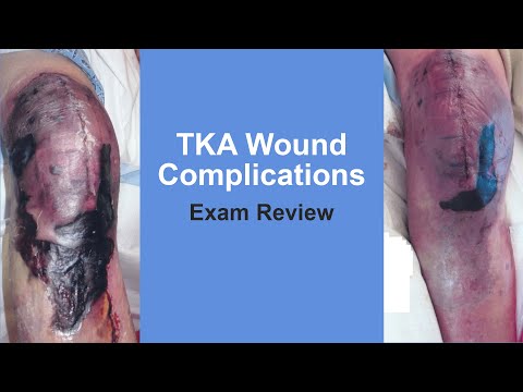 TKA Wound Complications Exam Review - Thomas Sculco, MD