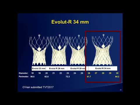 Evolut Pro: A Legacy of Superior Outcomes - Jeffrey Popma, MD