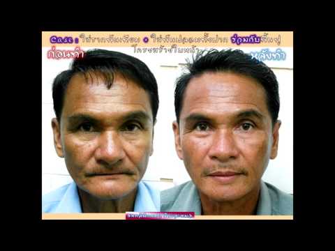 เพศ เต้านมซิลิโคน หญิงผ่าตัดเต้านม